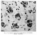 C. von Hosslin & A. Alzheimer, Ein Beitrag zur Klinik... Wellcome L0020584.jpg